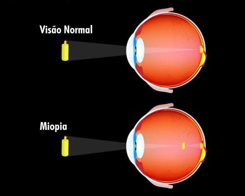 Ametropia (Miopia, Hipermetropia e Astigmatismo) (Doença)