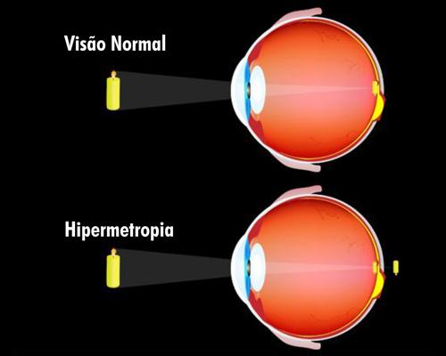 Ametropia (Miopia, Hipermetropia e Astigmatismo) (Doença)