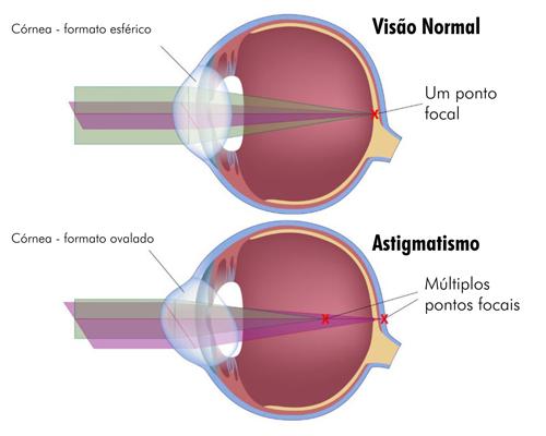 Ametropia (Miopia, Hipermetropia e Astigmatismo) (Doença)