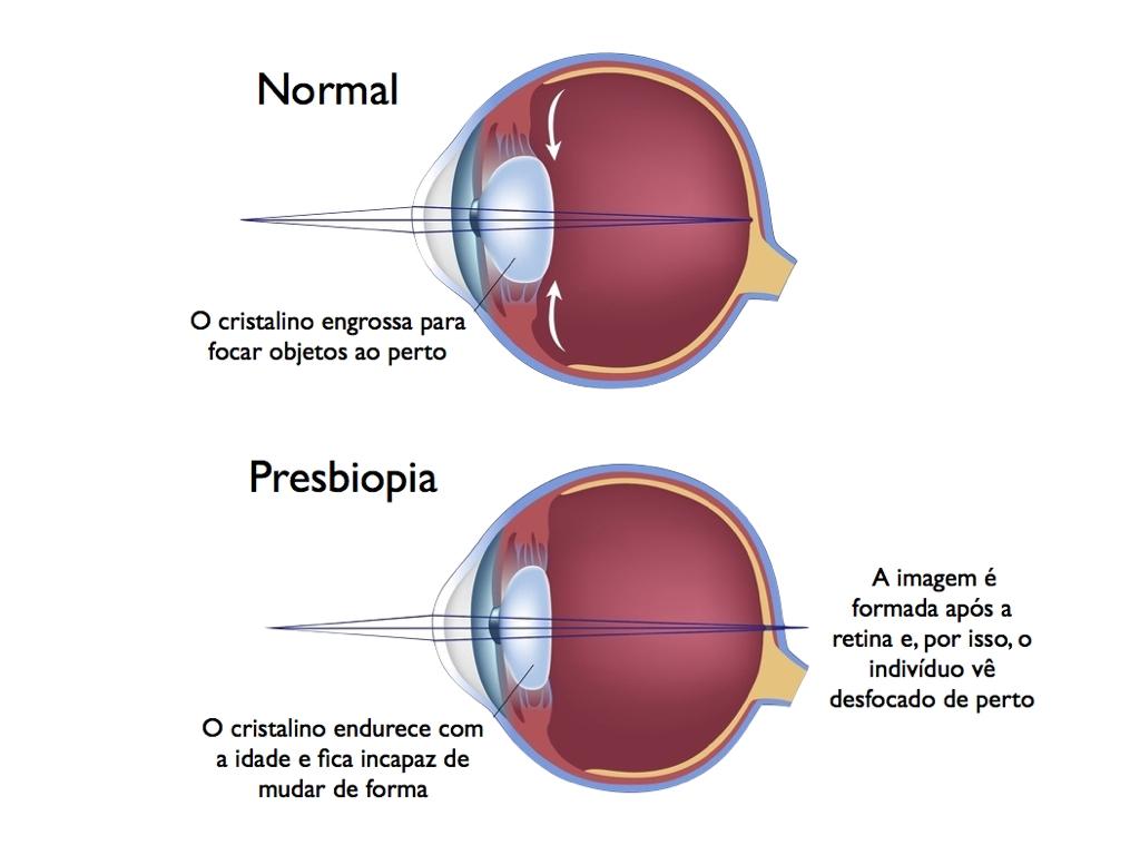 Ametropia (Presbiopia, Miopia, Hipermetropia e Astigmatismo) (Doença)